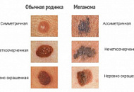 Лечение меланомы народными средствами Лечение меланомы народными средствами