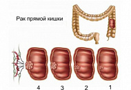 Лечение рака прямой кишки без операции Лечение рака прямой кишки без операции