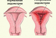 Народное лечение гиперплазии предстательной железы Народное лечение гиперплазии предстательной железы