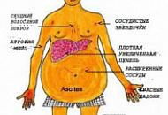 Лечение цирроза печени народными средствами