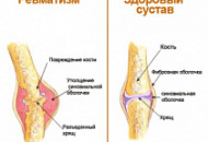 Лечение народными средствами ревматизма