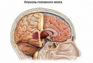 Классификация опухолей головного и спинного мозга