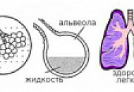 Лечение отека легких народными средствами Лечение отека легких народными средствами