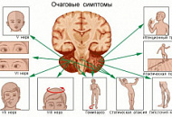Опухоль ствола головного мозга Опухоль ствола головного мозга