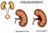Какие пить травы при пиелонефрите Какие пить травы при пиелонефрите