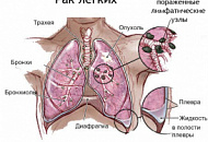 Лечение лисичками рака легких Лечение лисичками рака легких