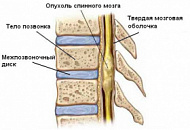 Народные методы лечения рака позвоночника