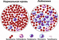 Народные методы лечения лимфомы и лейкемии Народные методы лечения лимфомы и лейкемии