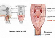 Рак гортани (горла)