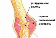 Травы от ревматизма
