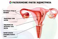 Сабельник при эндометриозе Сабельник при эндометриозе