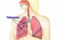 Бобровая струя при туберкулезе легких Бобровая струя при туберкулезе легких